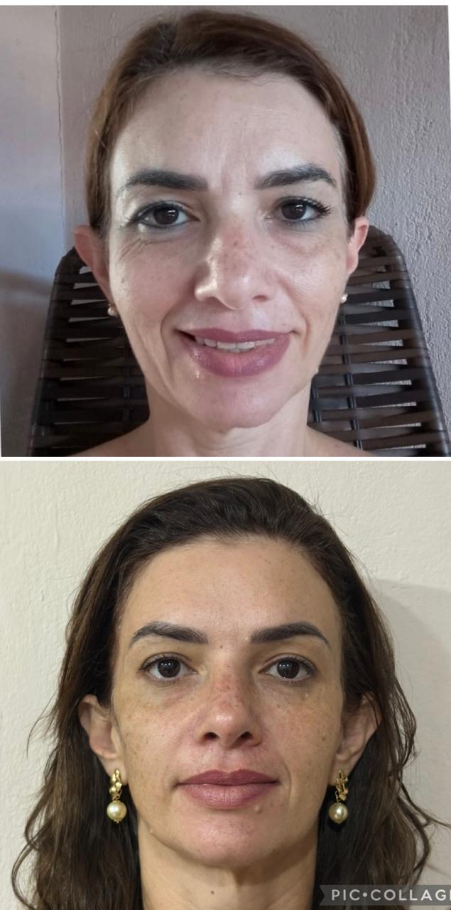 Antes e depois — harmonização facial