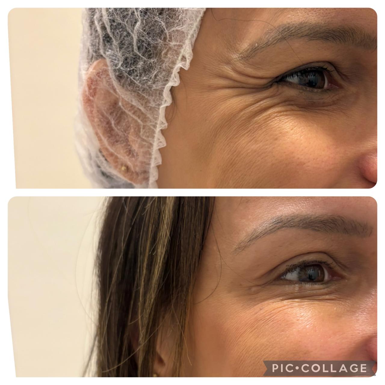 Antes e depois — toxina botulínica, pés de galinha