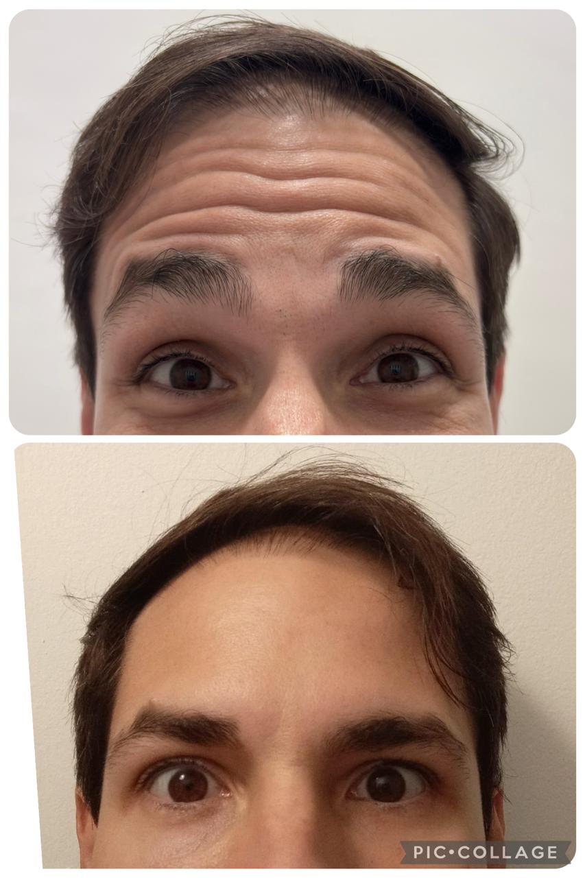 Antes e depois — toxina botulínica, testa